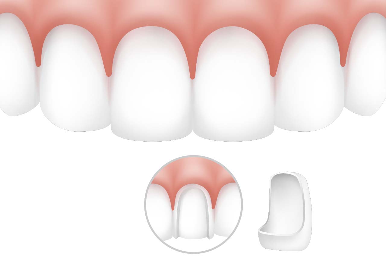 Veneers / Haftschalten zur Zahnaufhellung